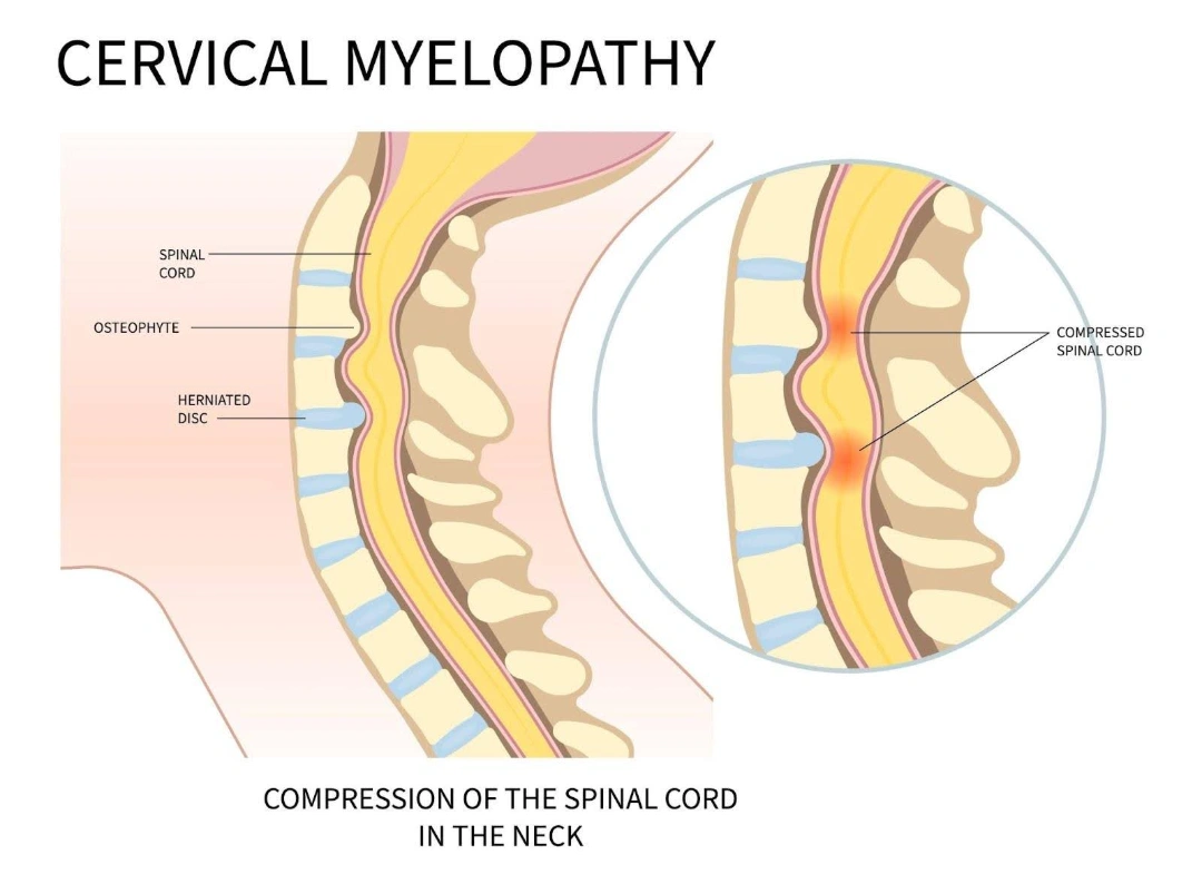 Cause of Neck Pain Singapore