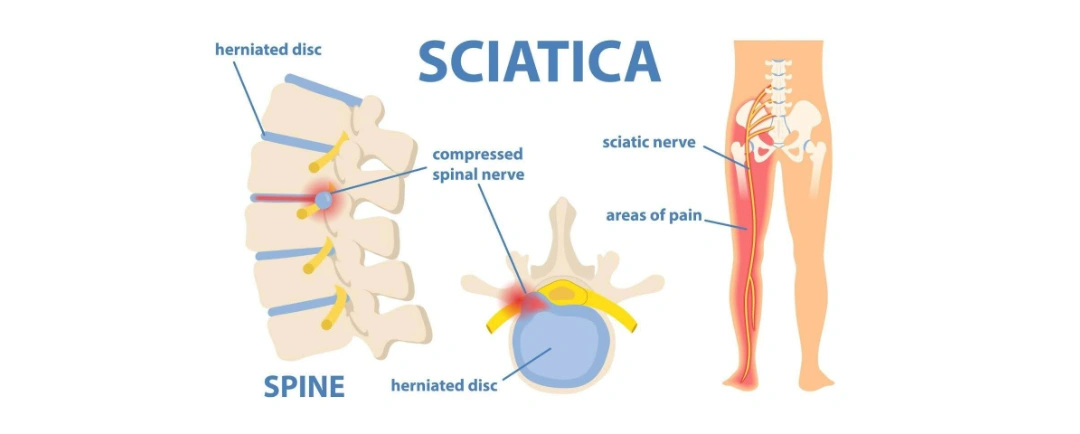 Symptoms of Lower Back Pain Singapore