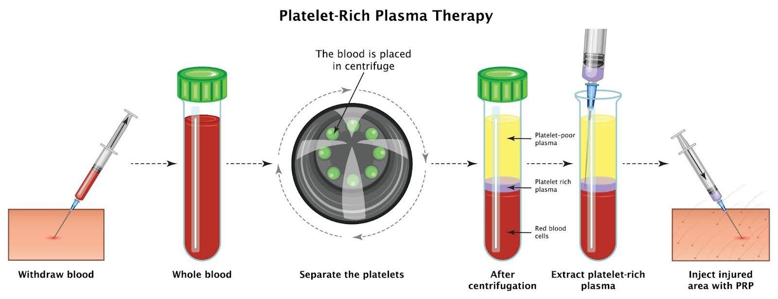 Platelet Rich Plasma (PRP) Injection Procedure Singapore