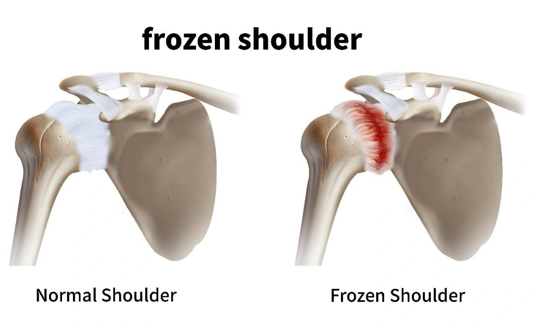 stages of frozen shoulder.