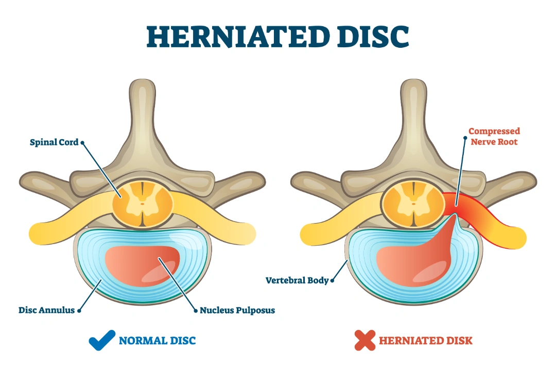 Slipped discs are caused by the tearing or rupture of the annulus of the disc.