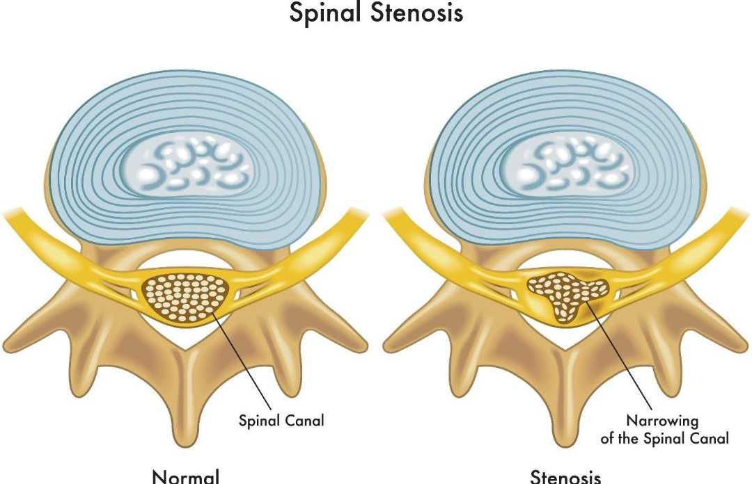 spinal stenosis treatment in Singapore.
