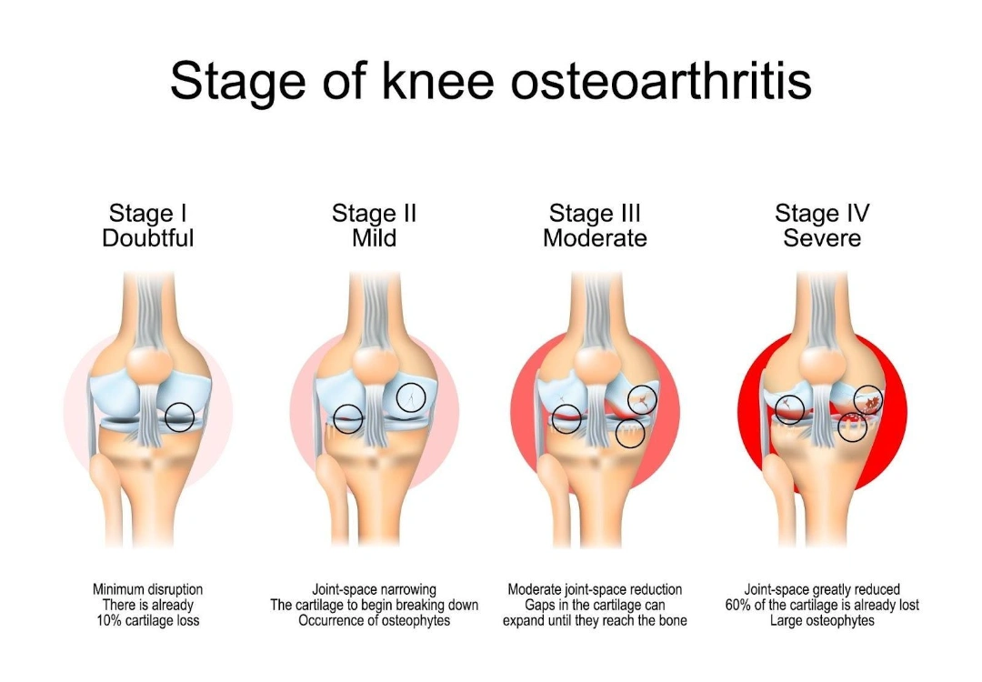 Stages of Knee Osteoarthritis Singapore