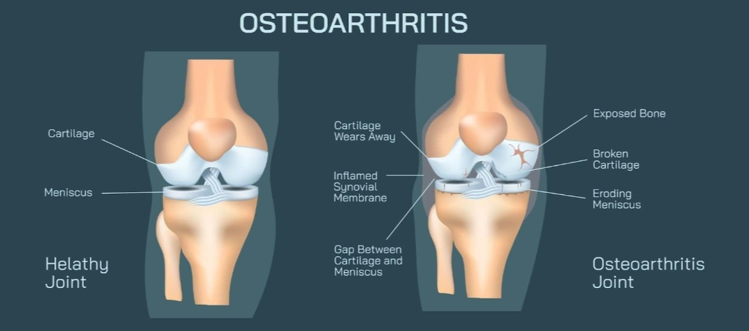 What Causes Knee Osteoarthritis in Singapore