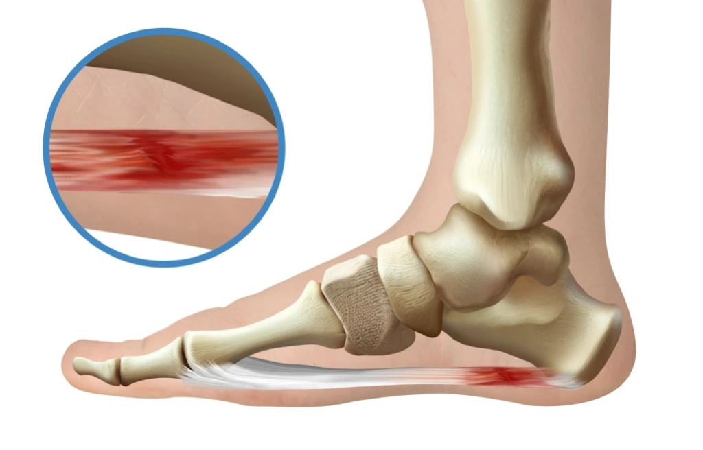 plantar fasciitis Singapore.