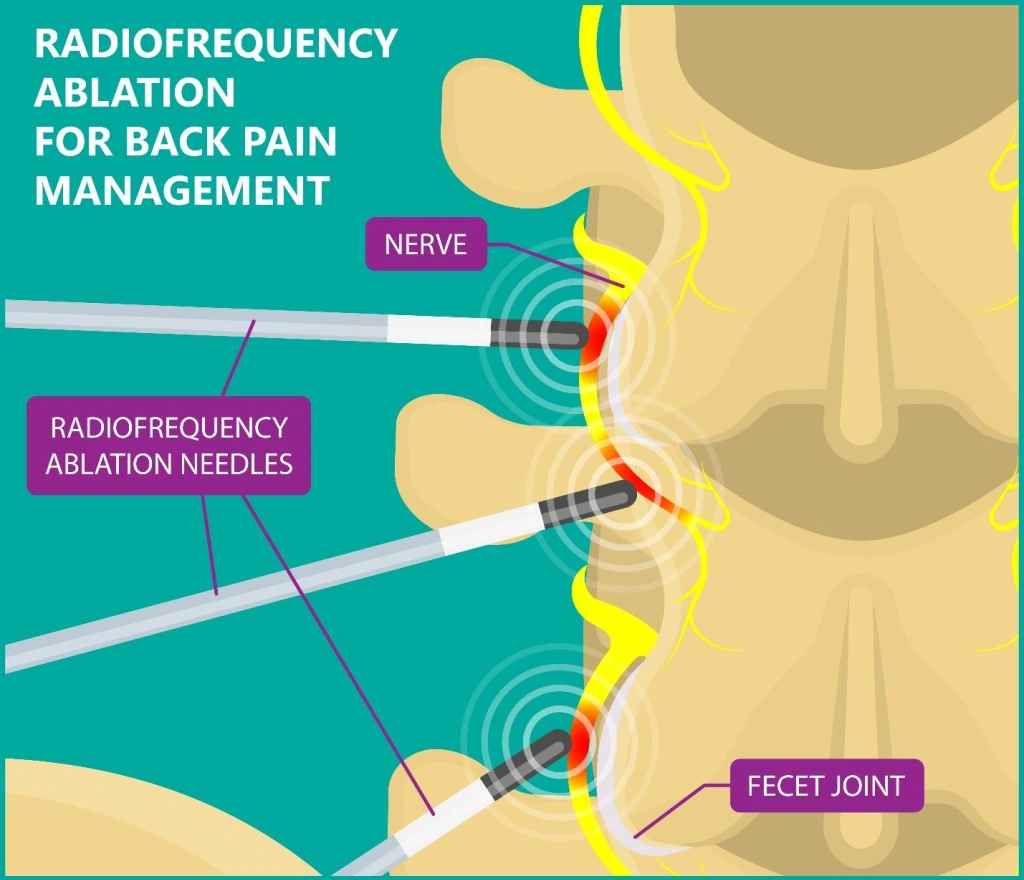 radiofrequency ablation procedure for chronic pain in Singapore.