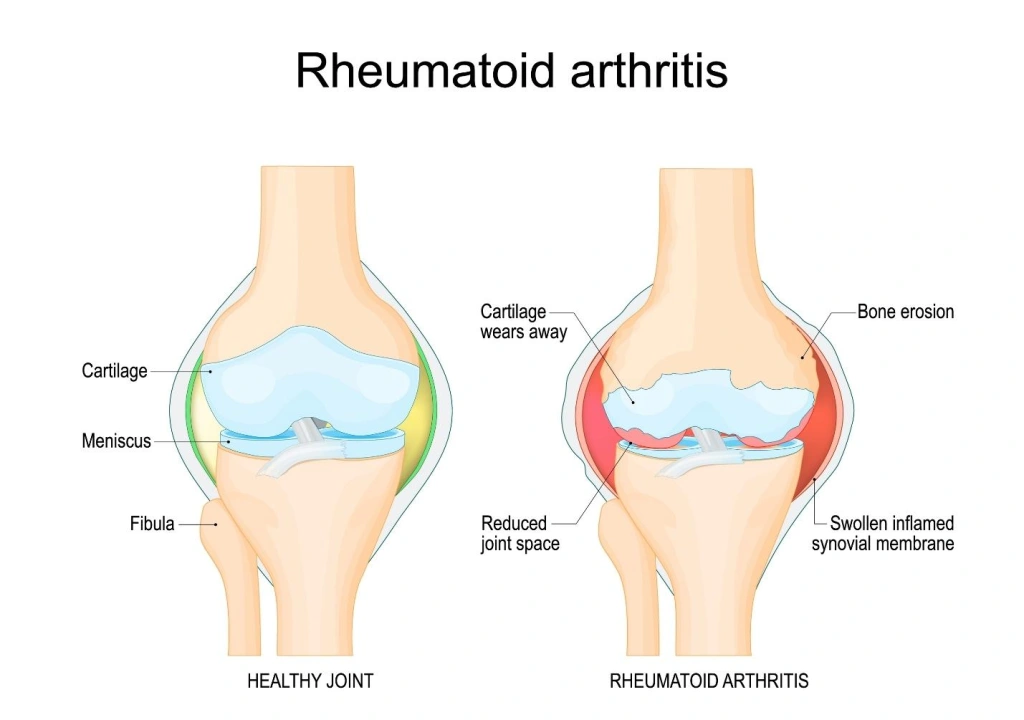 rheumatoid arthritis causes.