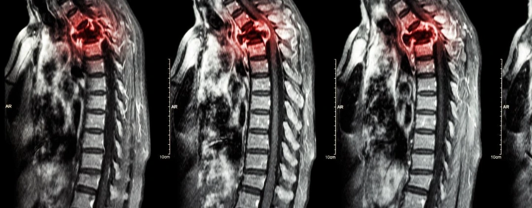 bone metastatic cancer pain treatment.