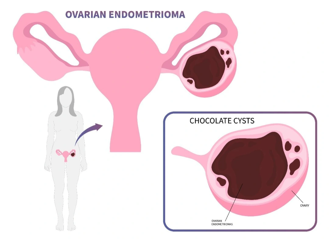 endometriomas Singapore.