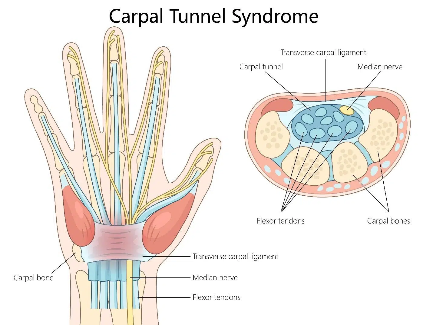 carpal tunnel causes.