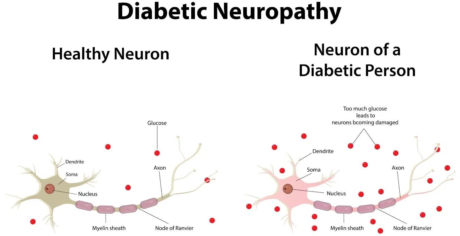 What Causes Diabetic Neuropathy Singapore