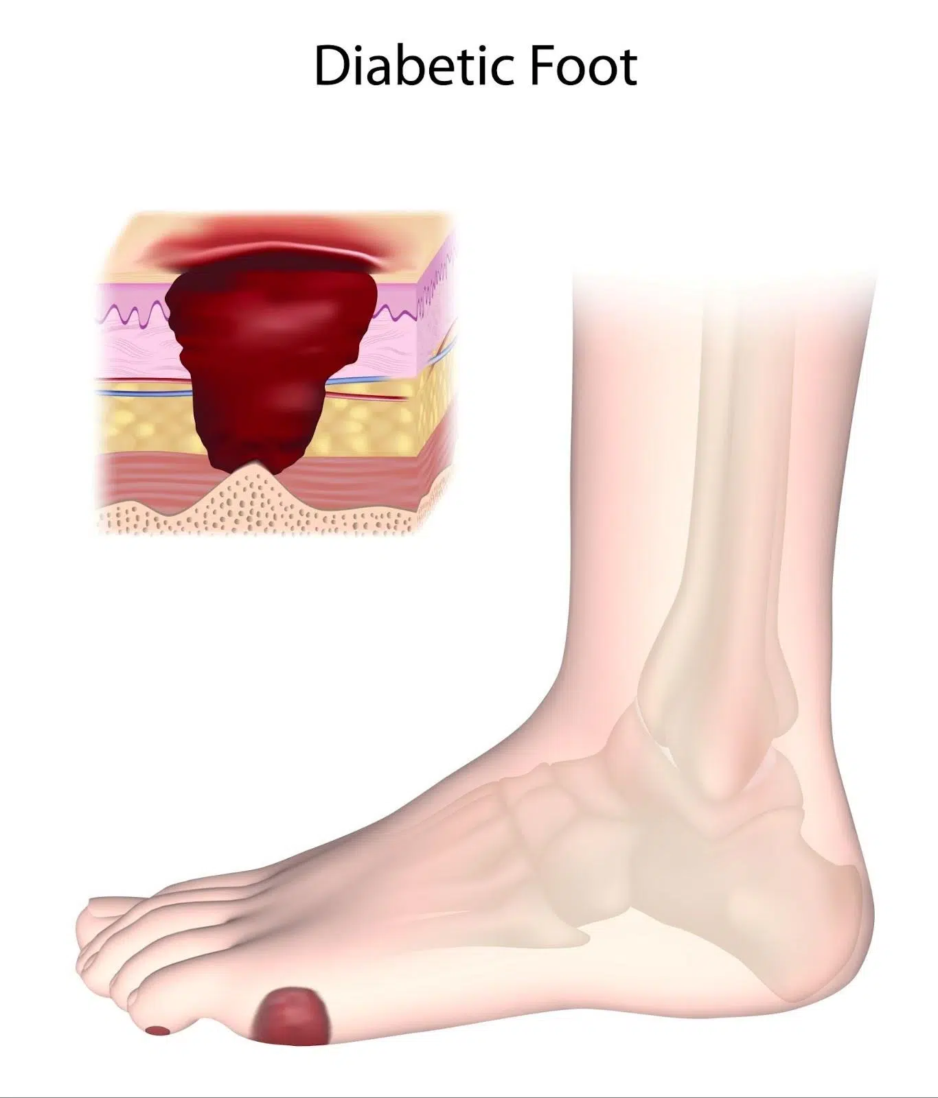 Symptoms of Diabetic Neuropathy Singapore