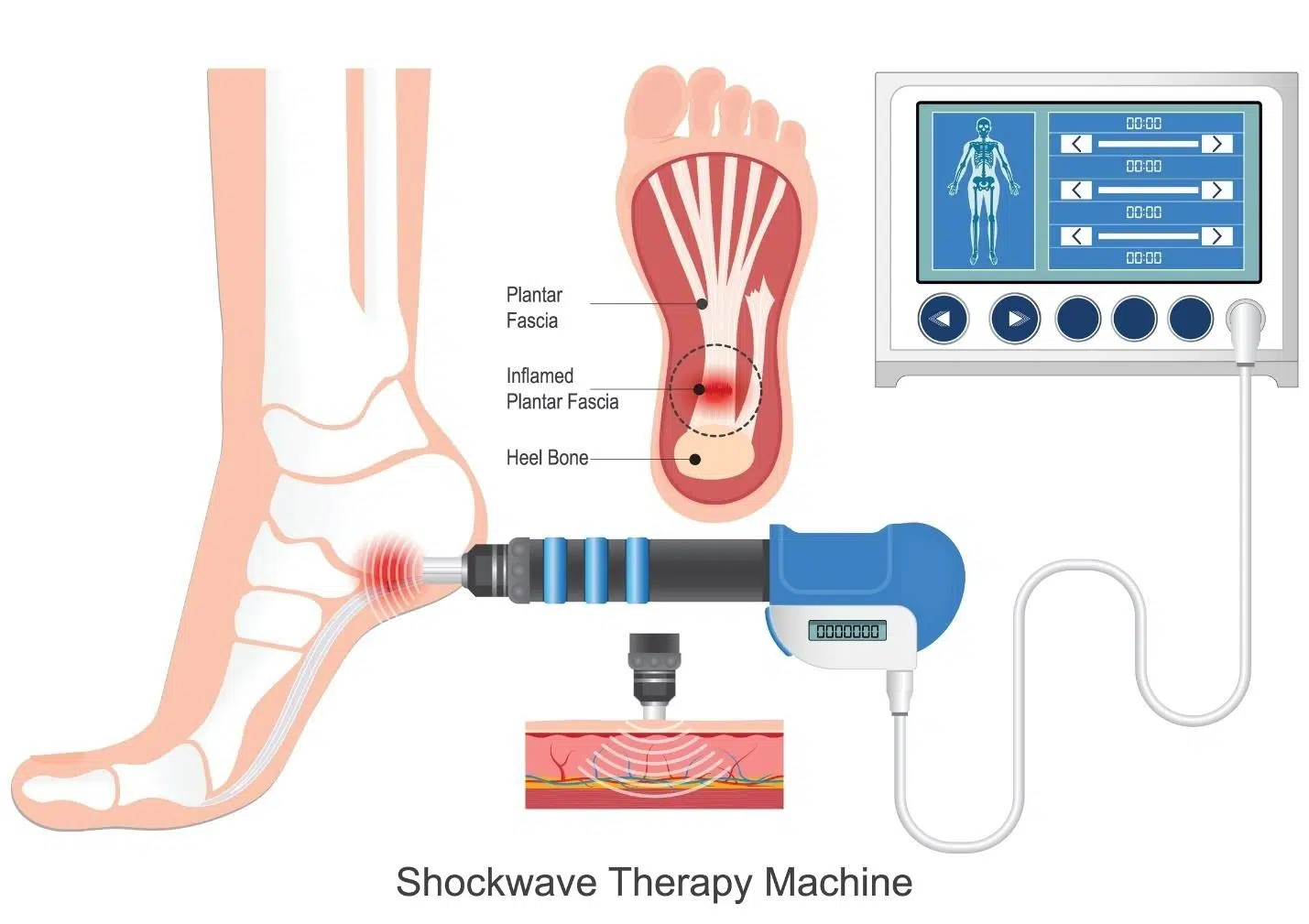 benefits of shockwave therapy for chronic pain.
