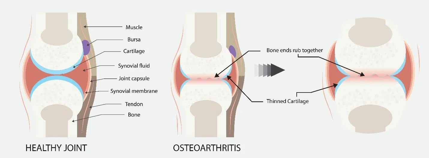 knee osteoarthritis treatment.