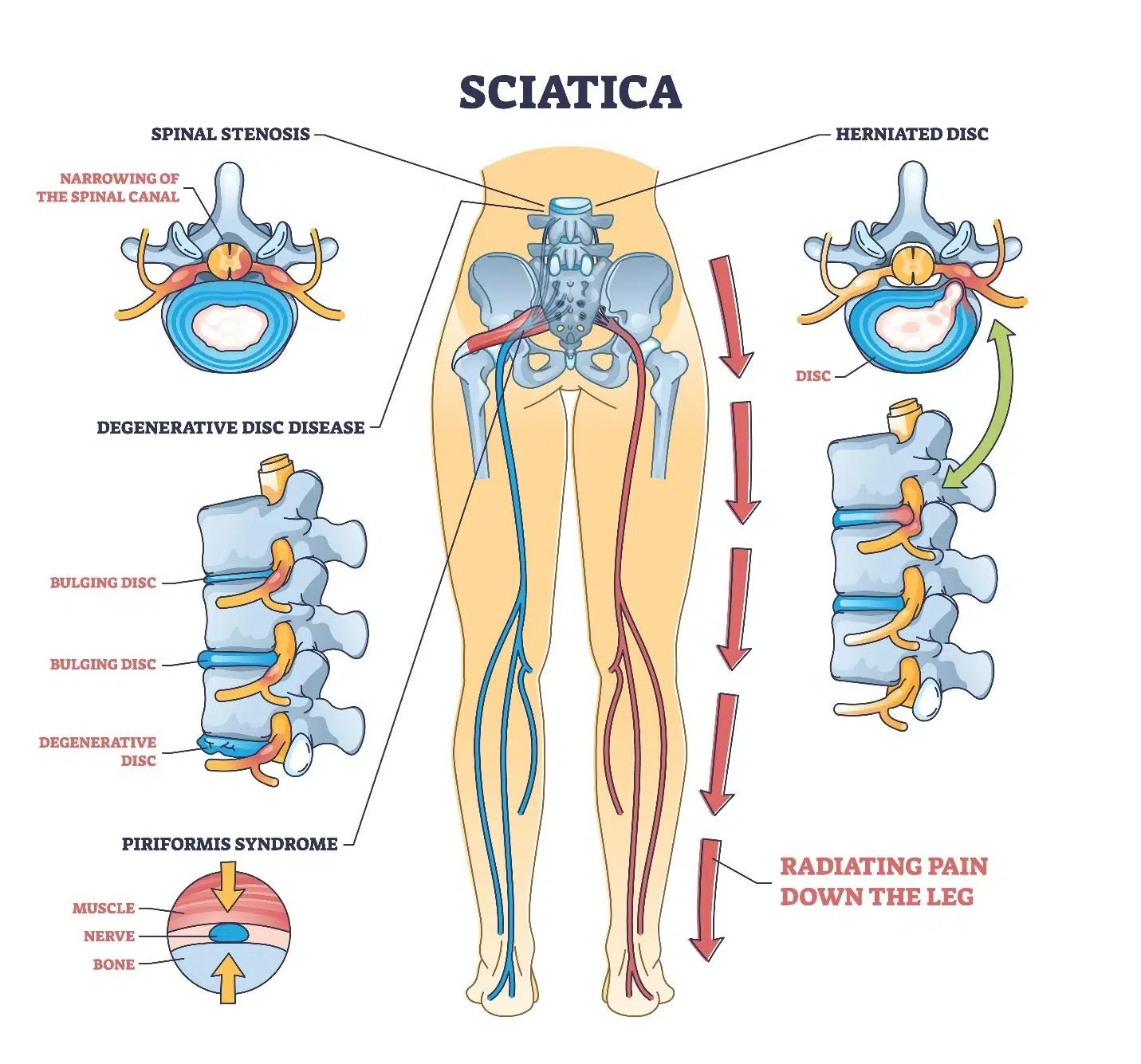 sciatica symptoms.