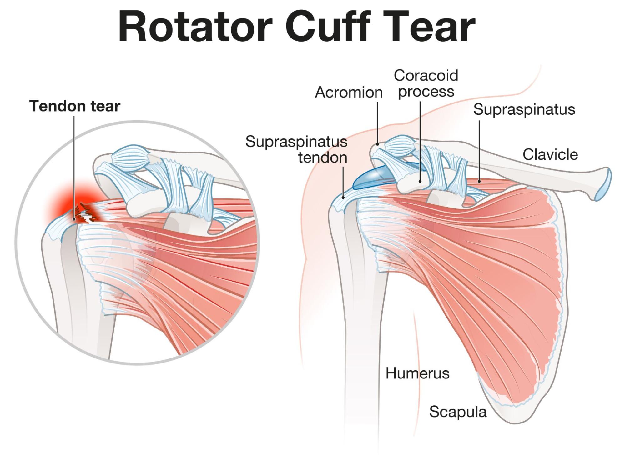 Rotator Cuff Tears Singapore