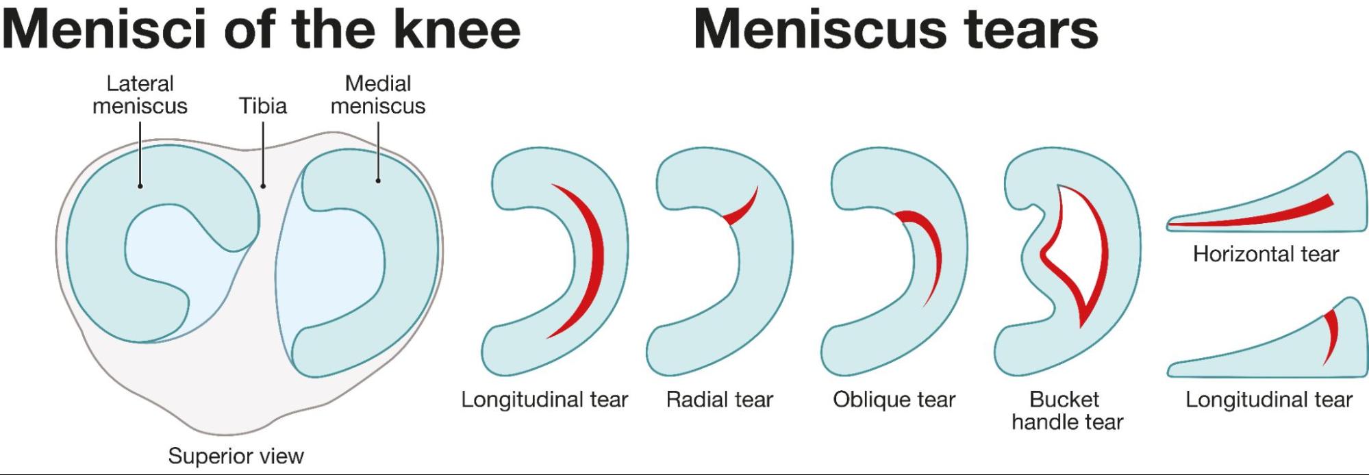 Meniscus Tears Singapore