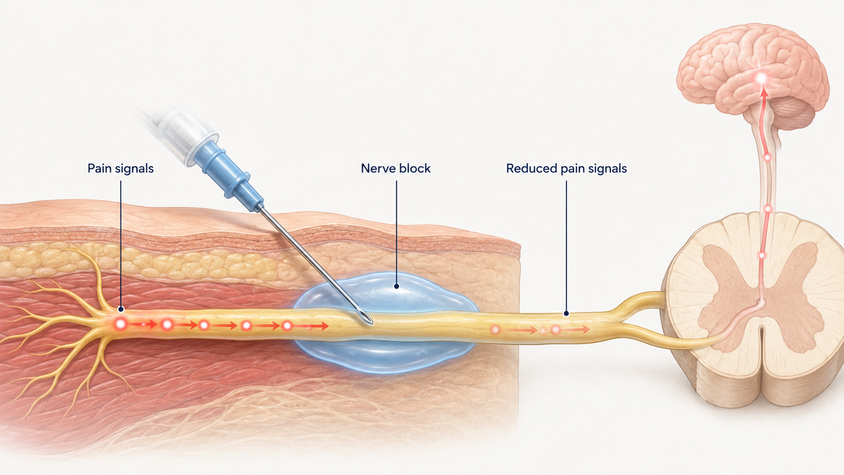 Nerve Block Singapore